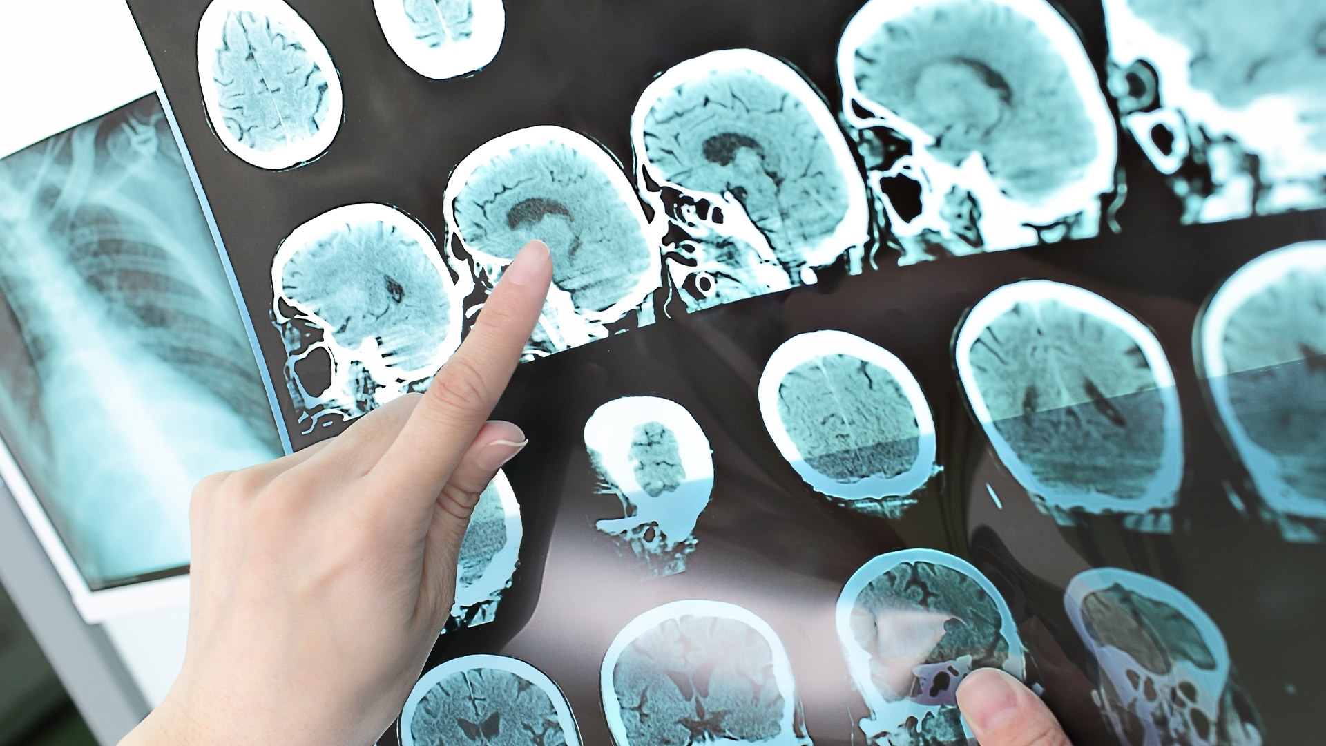 Westchester Neurological Consultants | Nerve Biopsy, EEG and VEEG and Sleep Disorders