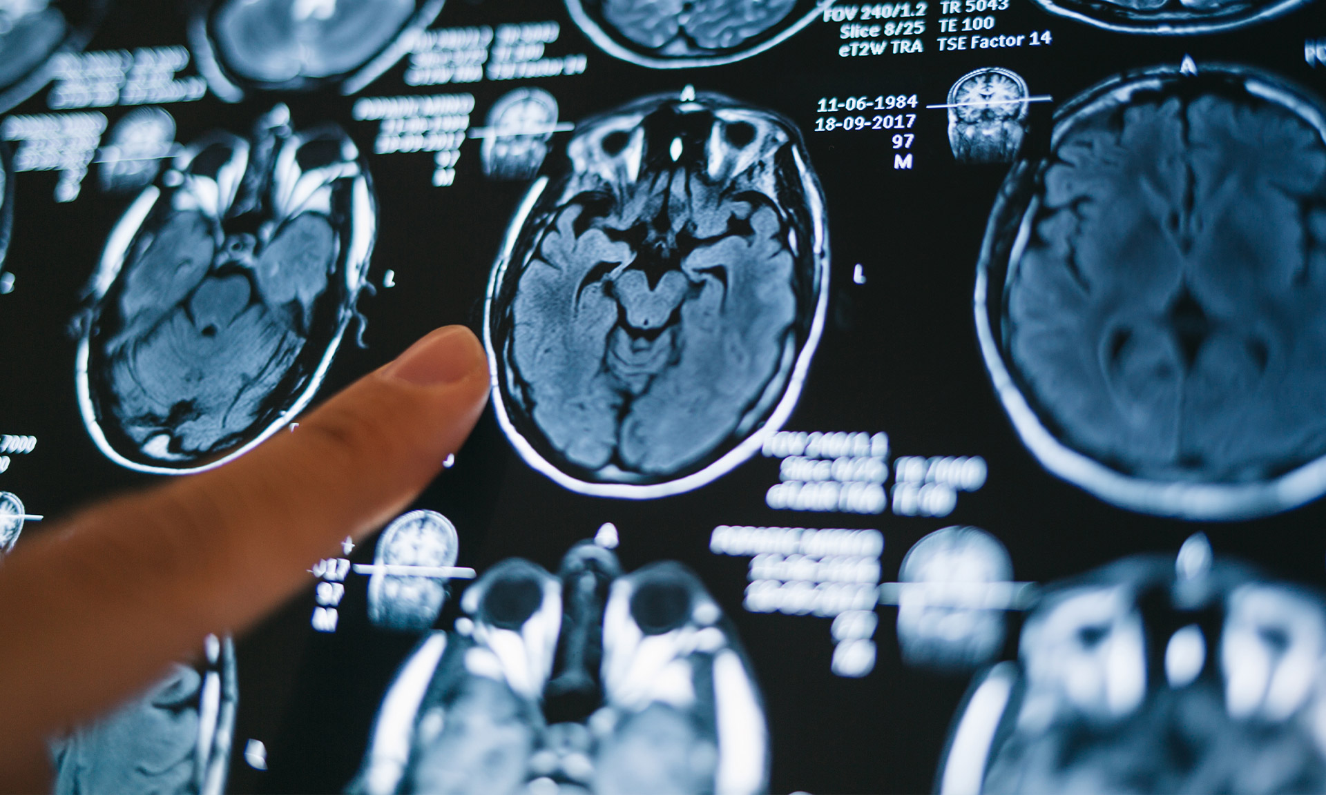 Westchester Neurological Consultants | Botox, Migraines and VNG Video Nystagmography